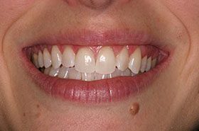Hill-After-1_Whitening-375x230_280wx185h