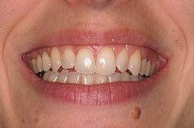 Hill-Before_Whitening-375x230_280wx185h