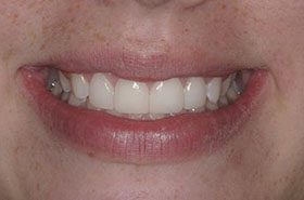 Hough-After_Veneers-Crowns-375x230_280wx185h