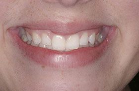 Hough-Before_Veneers-Crowns-375x230_280wx185h
