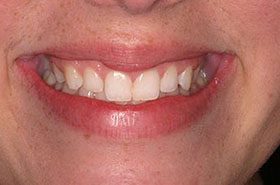 Hough-Before_Whitening-375x230_280wx185h
