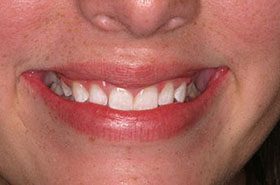 Hough-after_Whitening-375x230_280wx185h
