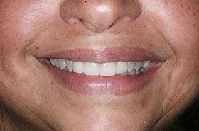 Jacobs-After_Veneers-Crowns-375x230_280wx185h
