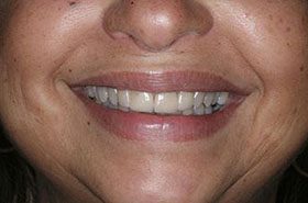 Jacobs-Before-2_Veneers-Crowns-375x230_280wx185h