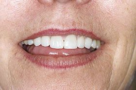 Jane-Jones-After_Veneers-Crowns-375x230_280wx185h