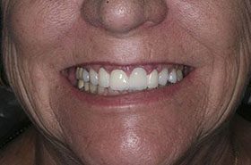 Jane-Jones-Before_Veneers-Crowns-375x230_280wx185h