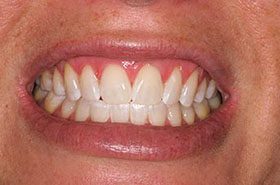 Jolea-After_Whitening-375x230_280wx185h
