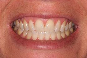 Jolea-Before_Whitening-375x230_280wx185h