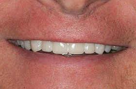Jones-Phillip-After_Veneers-Crowns-375x230_280wx185h