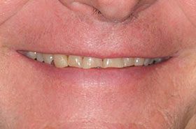 Jones-Phillip-before_Veneers-Crowns-375x230_280wx185h