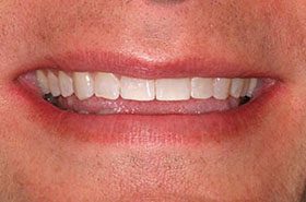Kahill-After_Whitening-375x230_280wx185h