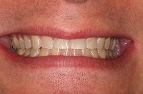 Kahill-Before_Whitening-375x230_280wx185h