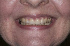 Kahn-After_Veneers-Crowns-375x230_280wx185h