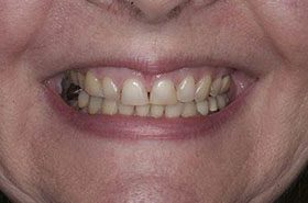 Kahn-Before_Veneers-Crowns-375x230_280wx185h