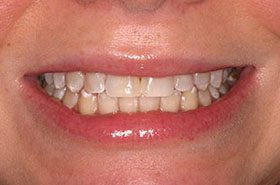 Kingston-After_Whitening-375x230_280wx185h