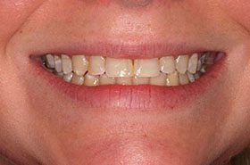 Kingston-Before_Whitening-375x230_280wx185h