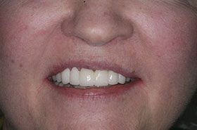 Knocke-After_Veneers-Crowns-375x230_280wx185h