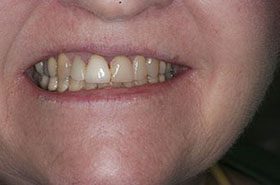 Knocke-Before_Veneers-Crowns-375x230_280wx185h