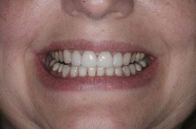 Labarre-After_Veneers-Crowns-375x230_280wx185h