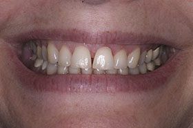 Labarre-Before_Veneers-Crowns-375x230_280wx185h