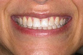 Laure-After_Whitening-375x230_280wx185h