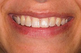 Laure-Before-1_Whitening-375x230_280wx185h