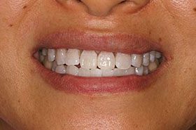 Li-After_Whitening-375x230_280wx185h