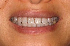 Li-Before_Whitening-375x230_280wx185h