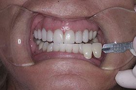 Lipar-Before_Veneers-Crowns-375x230_280wx185h