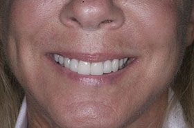Lipar-Seat_Veneers-Crowns-375x230_280wx185h