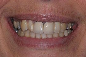 London-Before_Veneers-Crowns-375x230_280wx185h