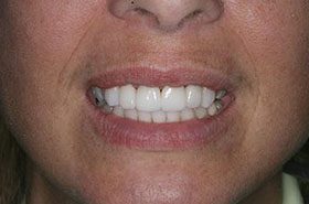 London-Seat_Veneers-Crowns-375x230_280wx185h