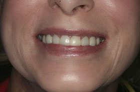 Loveless-Before_Veneers-Crowns-375x230_280wx185h