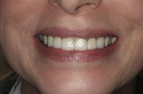 Loveless-Seat_Veneers-Crowns-375x230_280wx185h