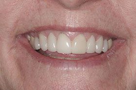 Marks-After_Veneers-Crowns-375x230_280wx185h