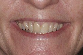 Marks-Before_Veneers-Crowns-375x230_280wx185h