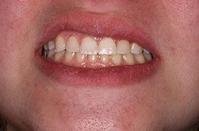 McCarthy-After_Bonding-375x230_280wx185h