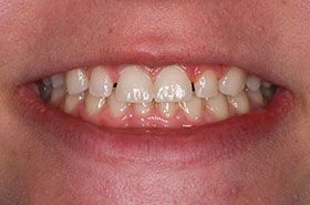 McCarthy-Before_Bonding-375x230_280wx185h