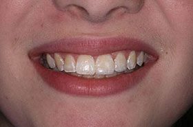 McGregor-After_Bonding-375x230_280wx185h