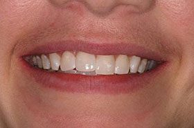Mitchell-After_Whitening-375x230_280wx185h