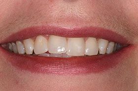 Mitchell-Before_Whitening-375x230_280wx185h