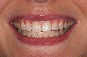 Monica-After_Whitening-375x230_280wx185h
