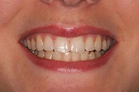 Monica-Before_Whitening-375x230_280wx185h