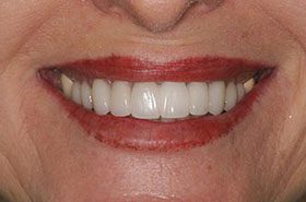 Moore-After_Veneers-Crowns-375x230_280wx185h
