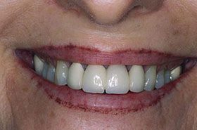 Moore-Before_Veneers-Crowns-375x230_280wx185h