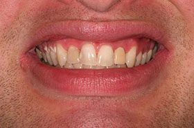 Neely-After_Whitening-375x230_280wx185h