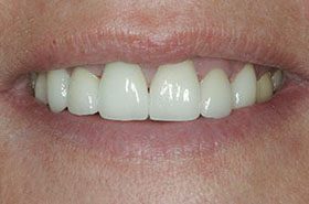 Nussa-After_Veneers-Crowns-375x230_280wx185h