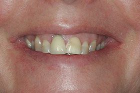 Nussa-Before_Veneers-Crowns-375x230_280wx185h