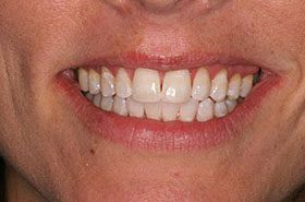Owen-After_Whitening-375x230_280wx185h