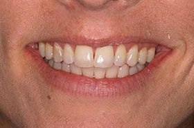 Owen-Before_Whitening-375x230_280wx185h